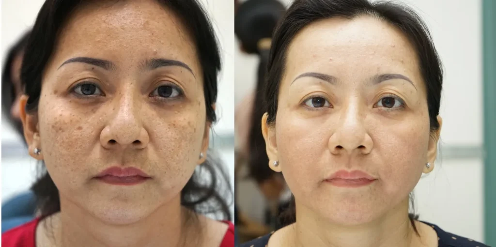 Các phương pháp hỗ trợ phục hồi da sau mụn chuyên nghiệp