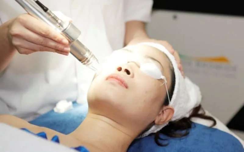 Chi phí điều trị mụn bằng laser và các yếu tố ảnh hưởng