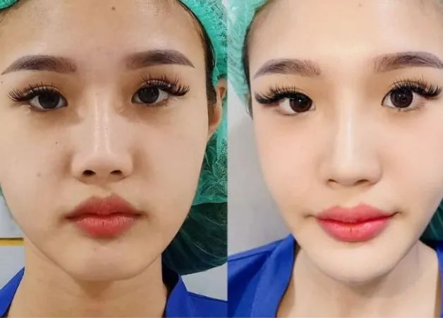 Độn cằm Vline là gì?