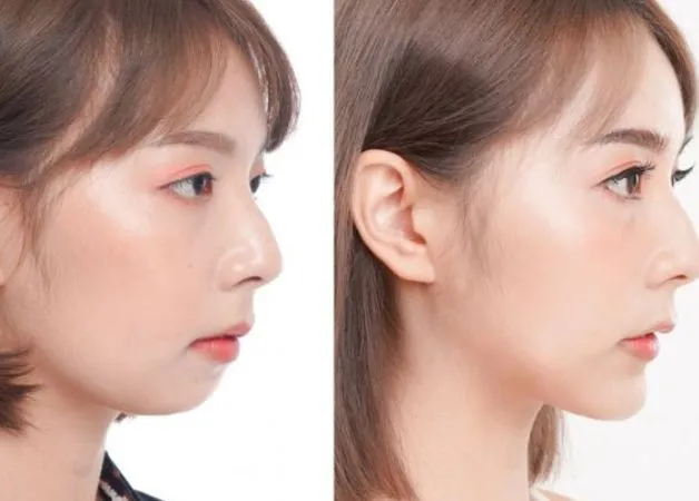 Kinh nghiệm thực tế và lời khuyên khi lựa chọn dịch vụ độn cằm Vline