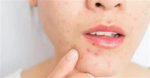 liệu trình phục hồi da sau mụn