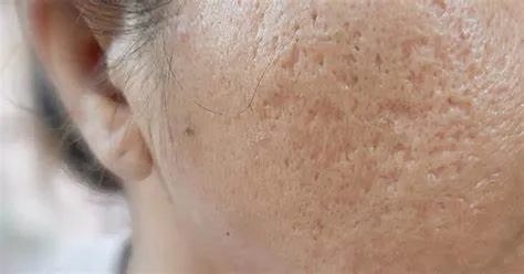 Lời khuyên từ chuyên gia da liễu: "Điều trị sẹo rỗ cần sự kết hợp và kiên nhẫn"