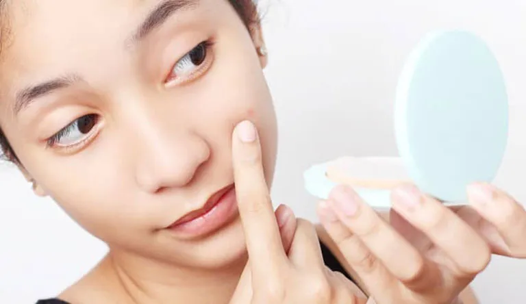 Mụn đầu đen: Những nốt mụn nhỏ li ti trên bề mặt da