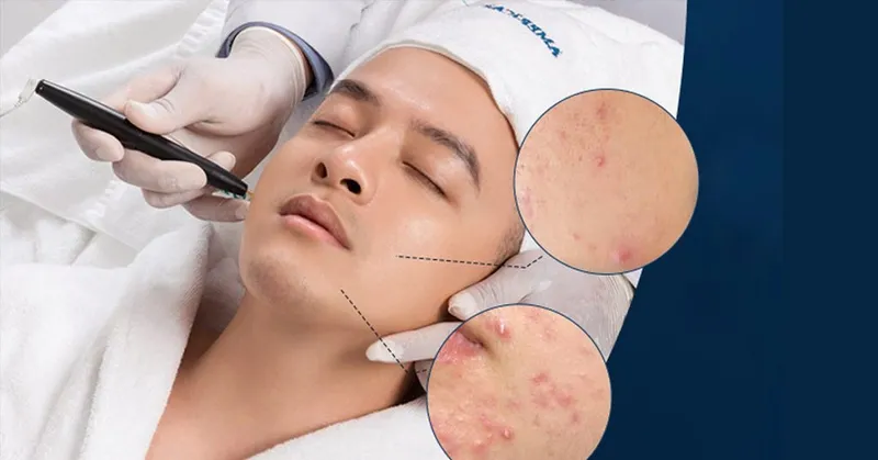 Mụn và nỗi lo không của riêng ai