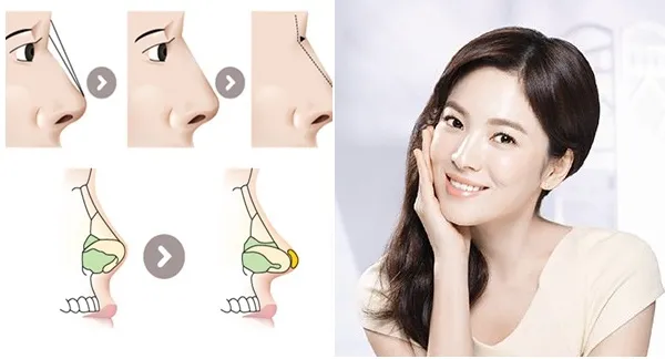 Nâng mũi cấu trúc là gì? Giải thích một cách dễ hiểu nhất