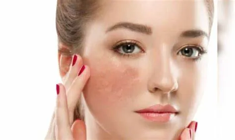 Peel da hóa học (Chemical Peel)