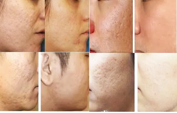 Sẹo chân đá nhọn (Ice Pick Scars)
