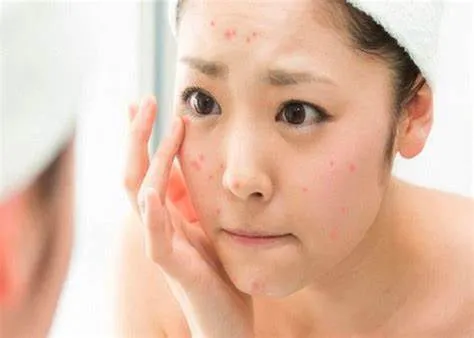 Tại sao cần phục hồi da sau mụn?