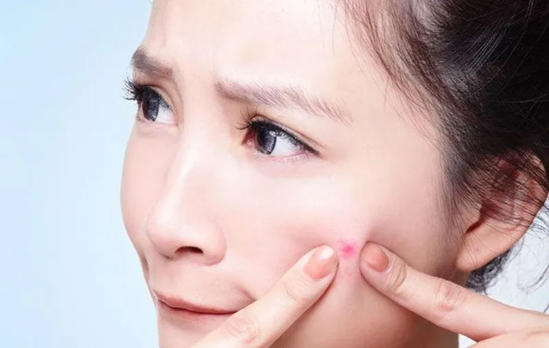 Thay đổi nội tiết tố: Nguyên nhân hàng đầu gây mụn