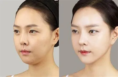 Thermage (trẻ hóa da bằng sóng tần số vô tuyến)