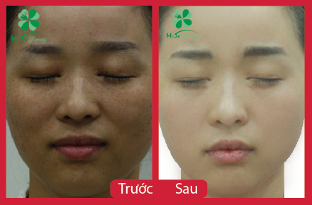 Trị nám Chị Hồng Ngọc