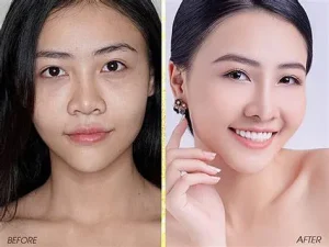 dịch vụ nâng mũi đẹp