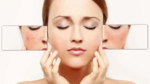 điều trị da tăng sắc tố