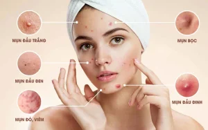 điều trị mụn tuổi dậy thì