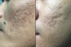 điều trị sẹo rỗ hiệu quả