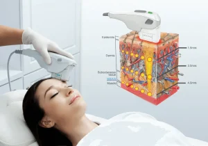 nâng cơ mặt bằng công nghệ HIFU