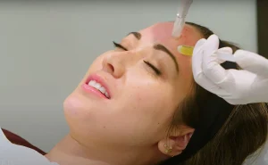 trẻ hóa da bằng PRP