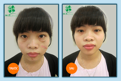 Trị sẹo lồi Chị Ngọc Hà