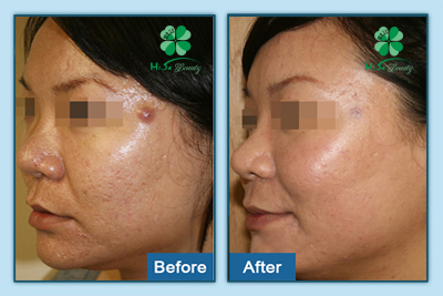 Trị mụn Chị Lan Anh
